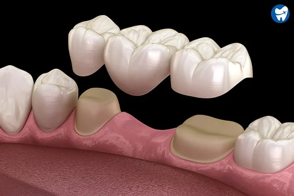 ক্যাপ, ব্রিজ এবং ডেনচার - Azam's Dental Care